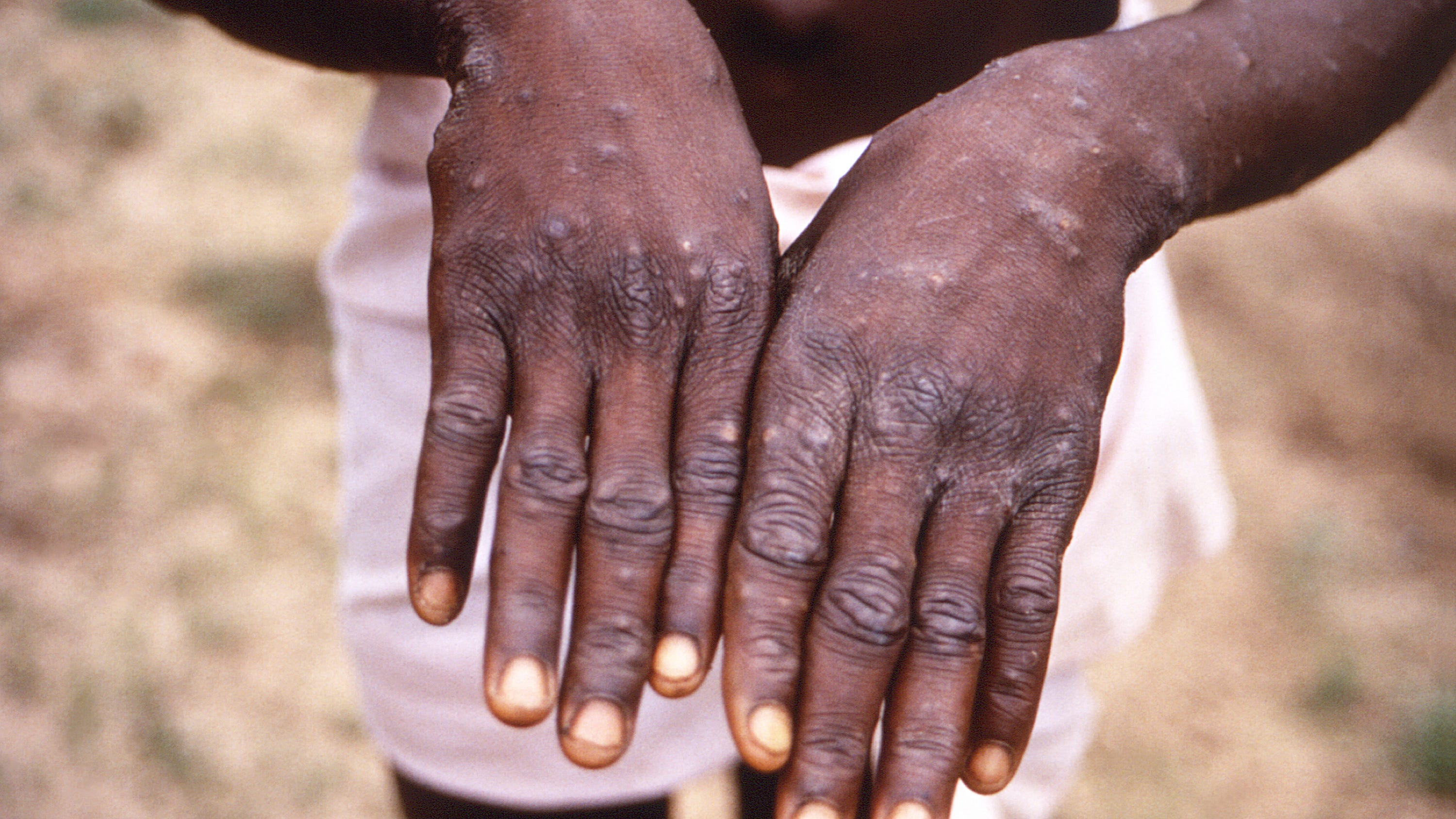 WHO again considers declaring monkeypox a global emergency