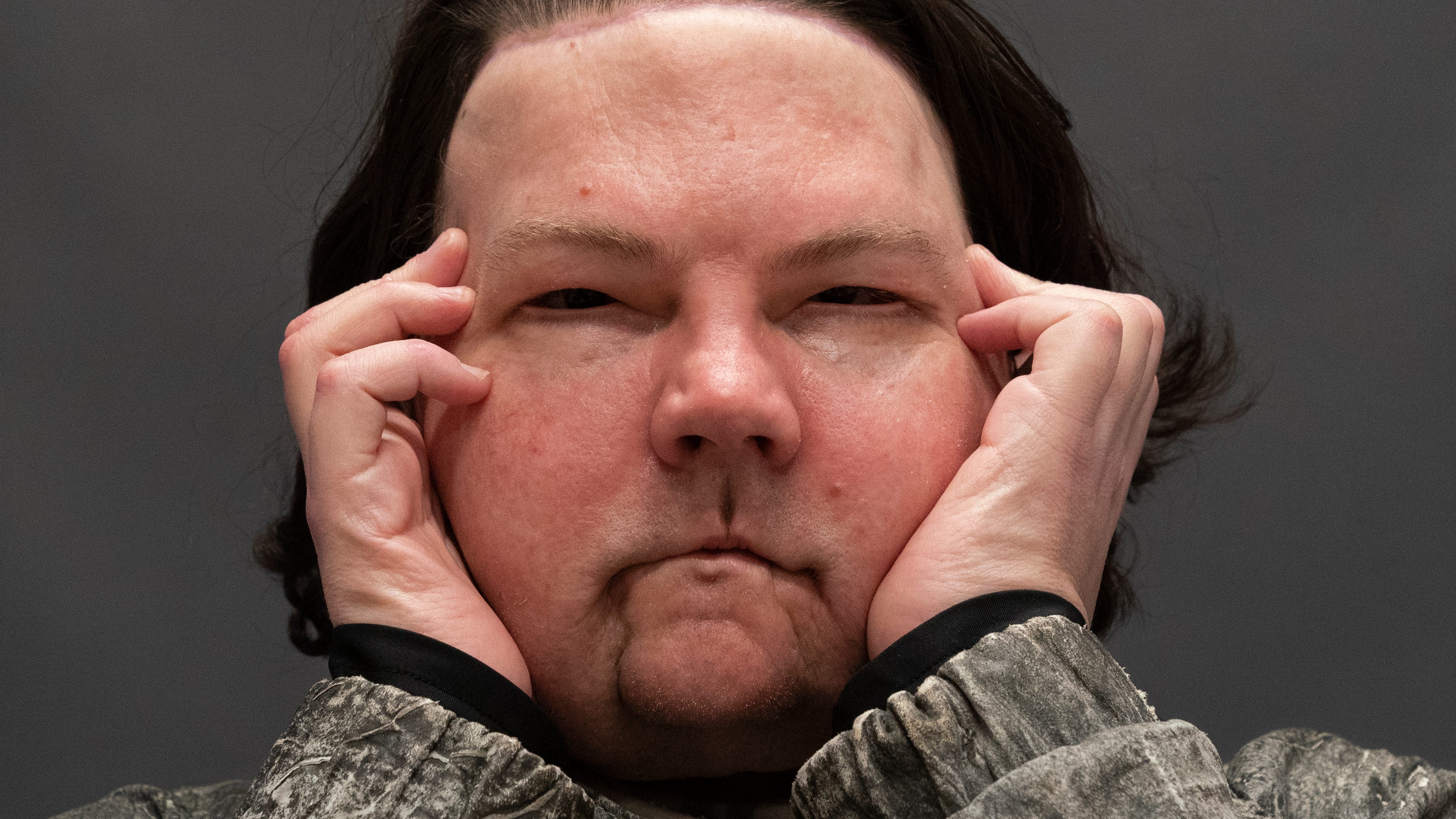 'New chance at life': Man gets face, hands in rare surgery 
