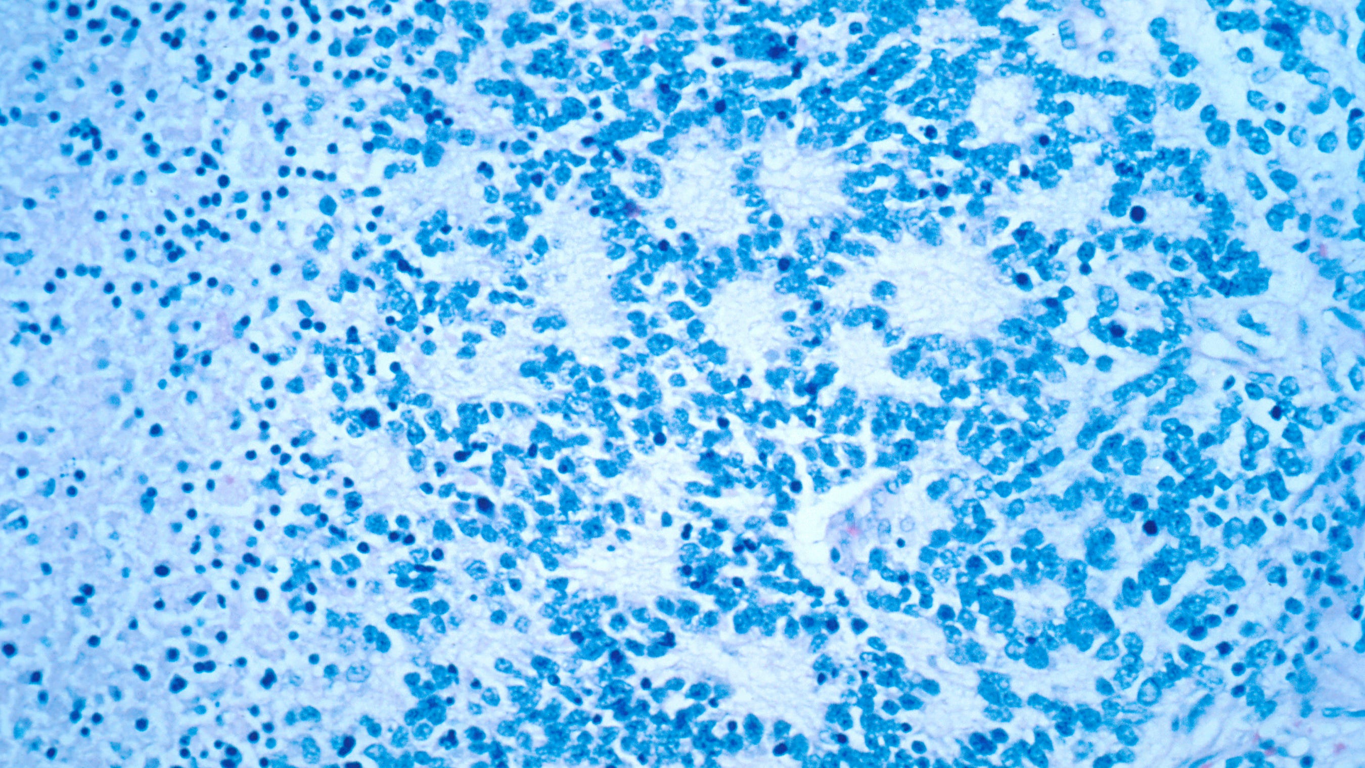 Novel treatment shows promise against rare cancer in kids
