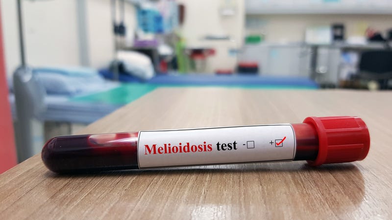 Positive Melioidosis test and laboratory sample of blood testing for diagnosis. This bacterial disease caused by Burkholderia pseudomallei infection. 
