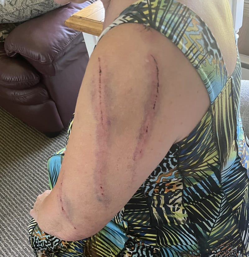 The Minneapolis woman attacked by a black bear. 