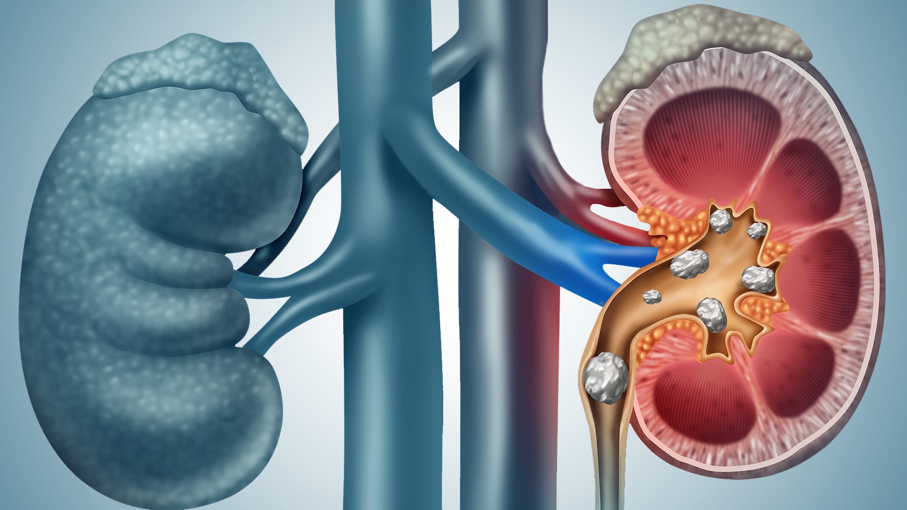 Everything to Know about Kidney Stones