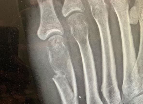 Rebekah's Broken Foot
