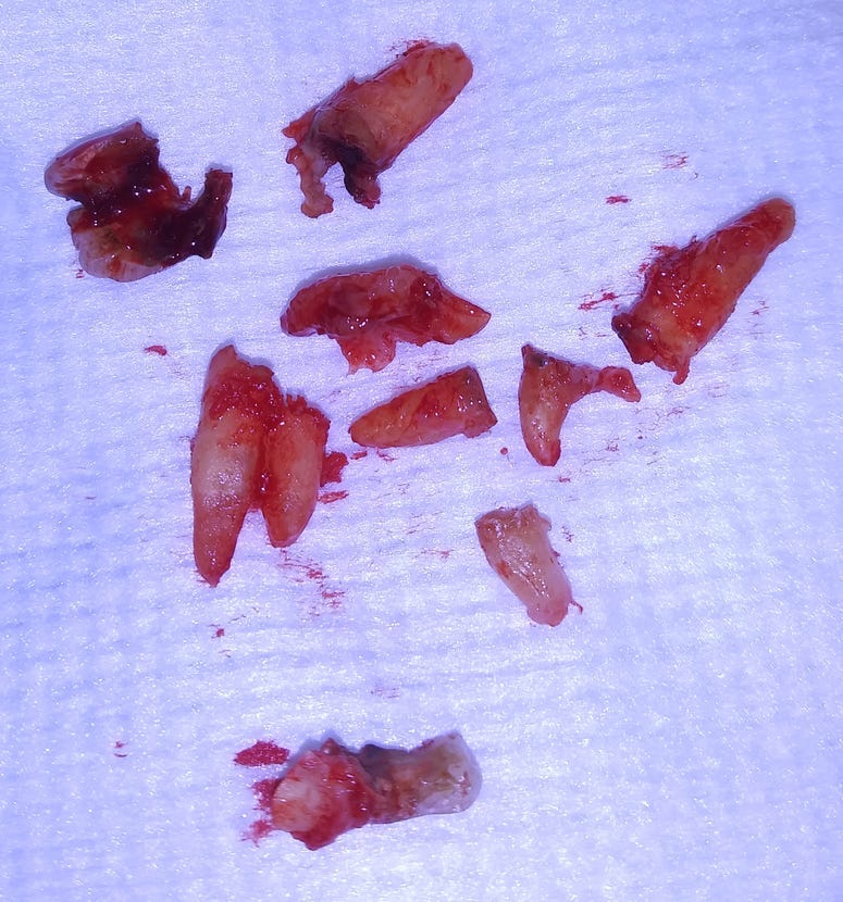 Bubba's Broken Teeth