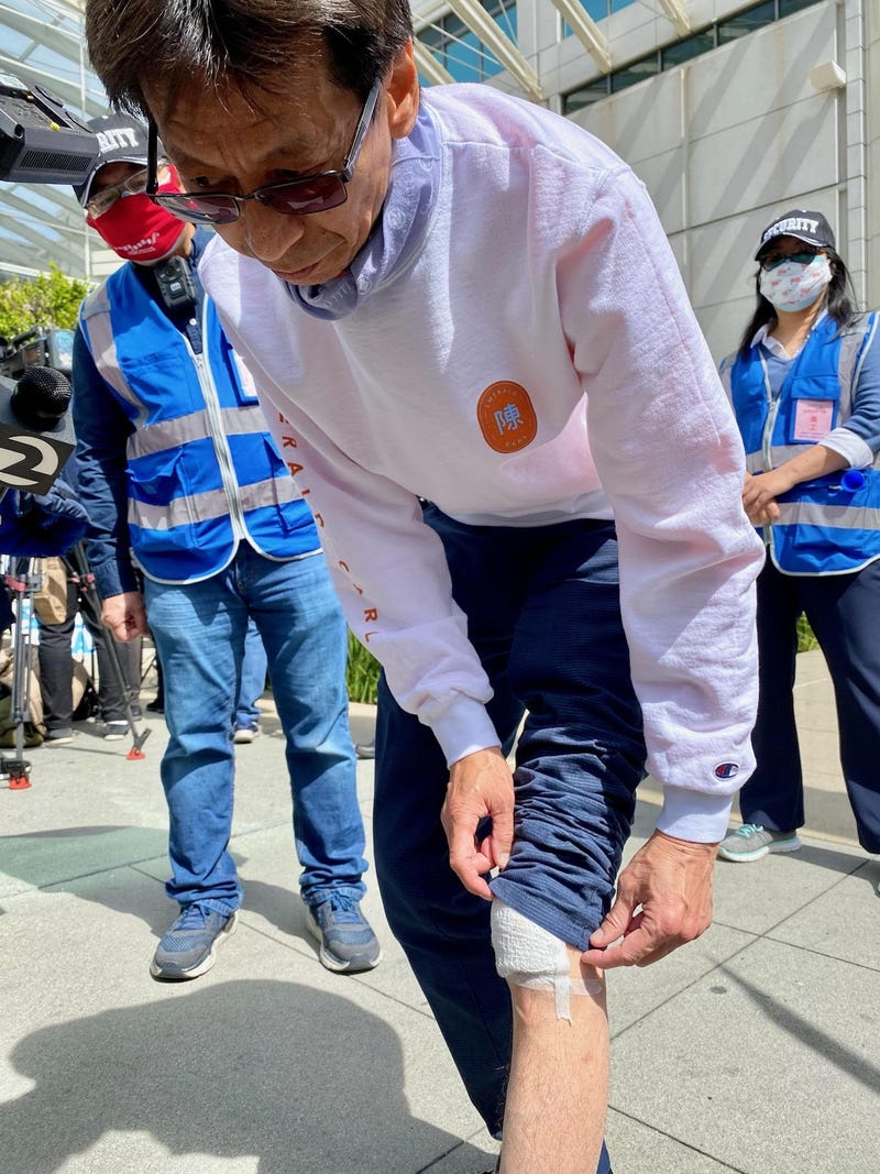 Carl Chan displays injuries sustained during an assault on Apr. 29, 2021