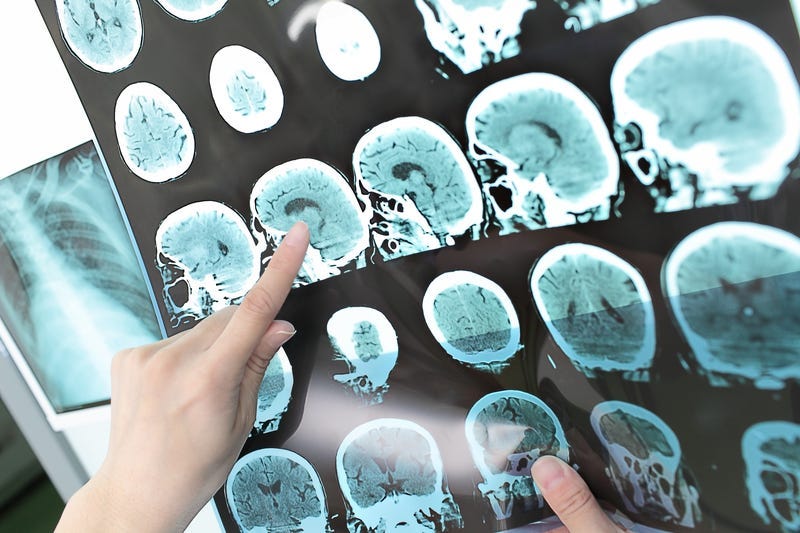 brain tumor