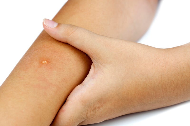 Arm_Infected_Measles