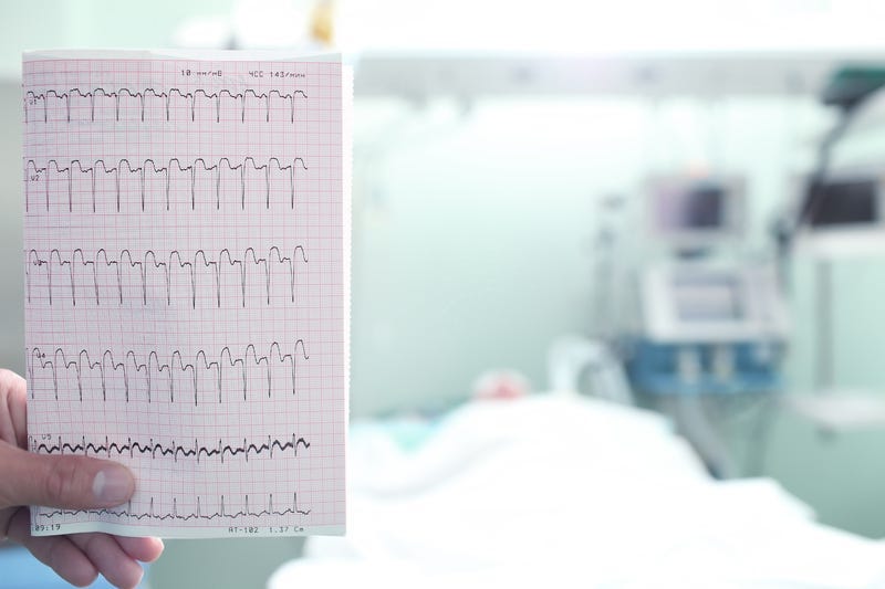 ECG with a heart attack in hospital ward