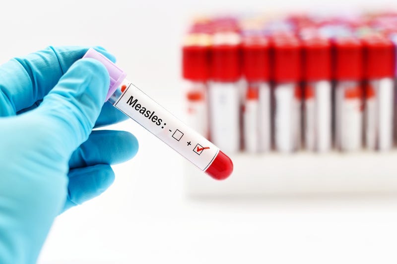 Measles