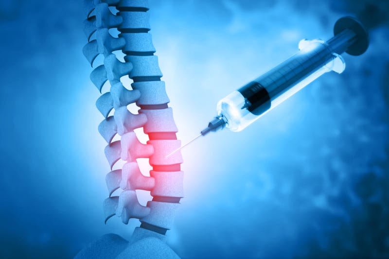epidural