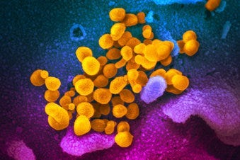 This undated electron microscope image made available by the U.S. National Institutes of Health in February 2020 shows the Novel Coronavirus SARS-CoV-2, yellow, emerging from the surface of cells, blue/pink, cultured in the lab. (NIAID-RML via AP)