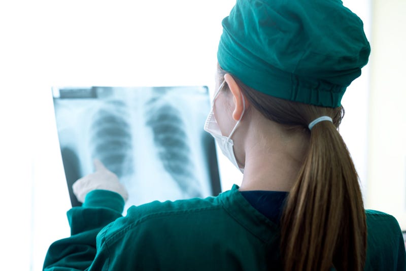 Tuberculosis X-ray