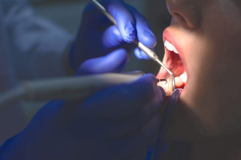 Dentist, Teeth, Cleaning, Stone Removal Procedure
