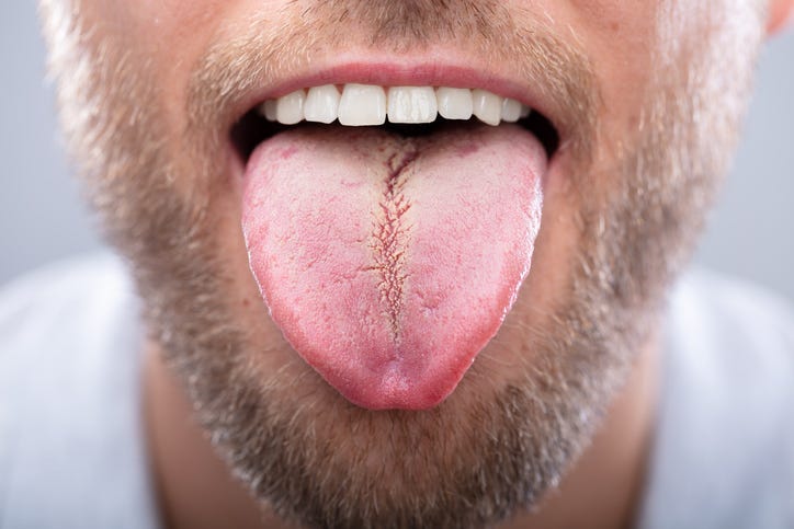 tongue dgs