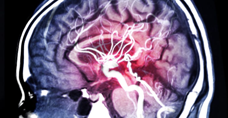 brain-hemorrhage-GettyImages-1147332261.jpg