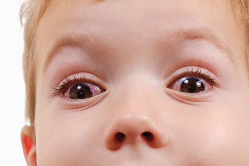 Child with pink eye