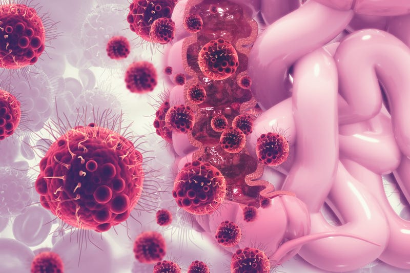 Colorectal Cancer