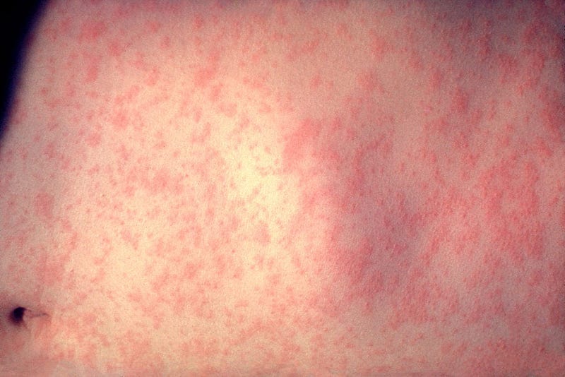 In this handout from the Centers for Disease Control and Prevention (CDC), the skin of a patient after three days of measles infection is seen at a New York hospital in 1958.