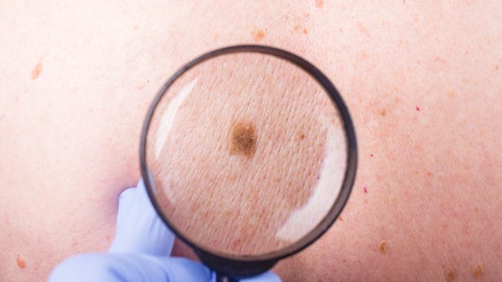 Does genetics play a role in how likely you are to get skin cancer?
