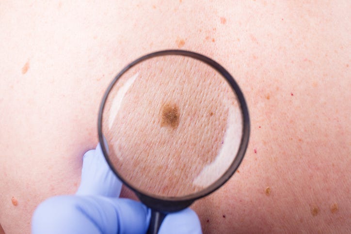 Skin cancer.