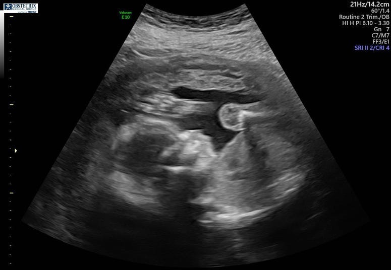 ultrasound