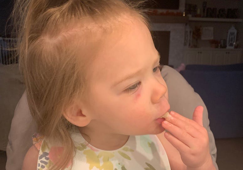 Lilly's First Black Eye