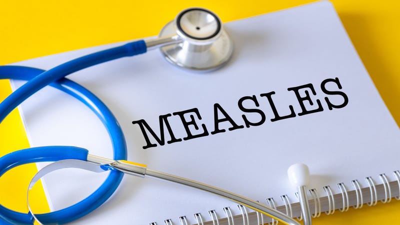 Measles, an acute viral respiratory disease  - stock photo