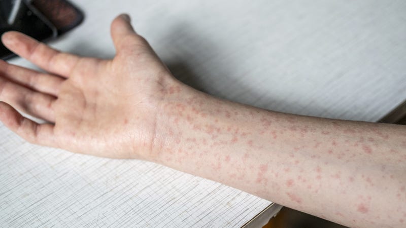 A teenager's hands covered in a measles rash - stock photo