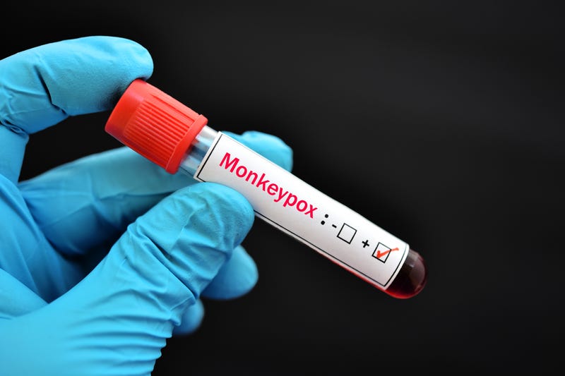 A vial of blood with the monkeypox virus