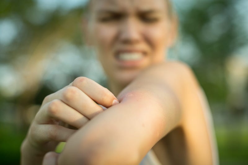 Mosquito bite