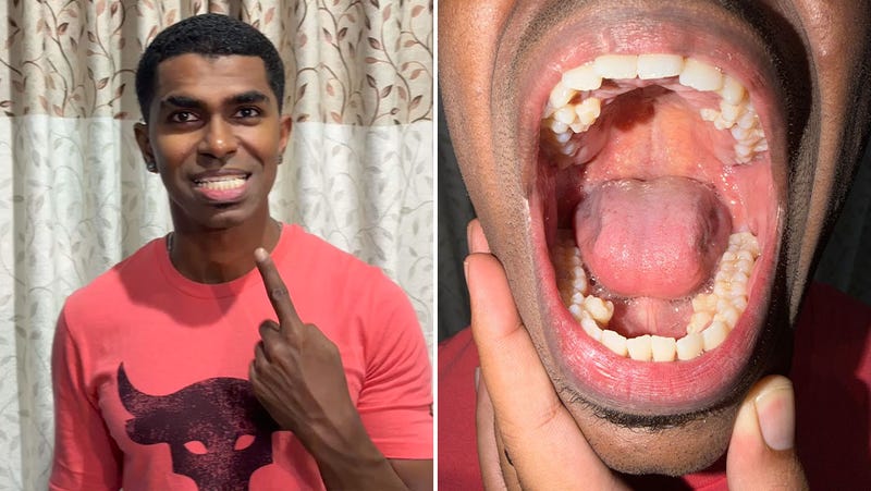Prathab Muniandy, from Klang in Selangor, Malaysia, has been verified by Guinness World Records as holding the record for most teeth in a person's mouth - a remarkable 42, confirmed by two dentists on December 28, 2023. The average adult has 32 teeth.