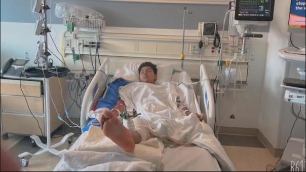 Orphan hit by alleged drunk driver in Santa Monica, loses one leg and may lose the other