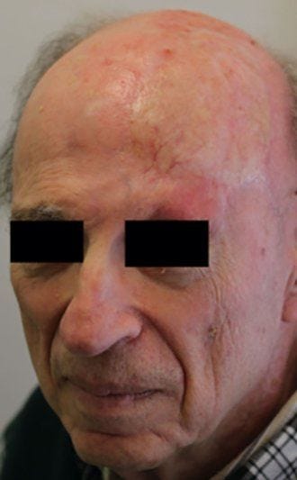 Pairing the top layer of the skin with pigmented tissue results in a better match.