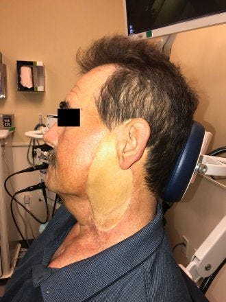Grafting skin from the thigh is typically used in facial reconstruction but may result in poor color match.
