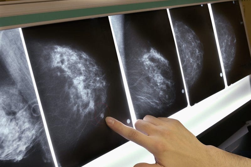 breast cancer