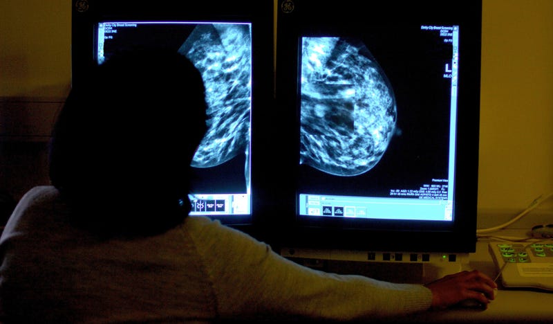 A consultant studying a mammogram of a woman's breast. 