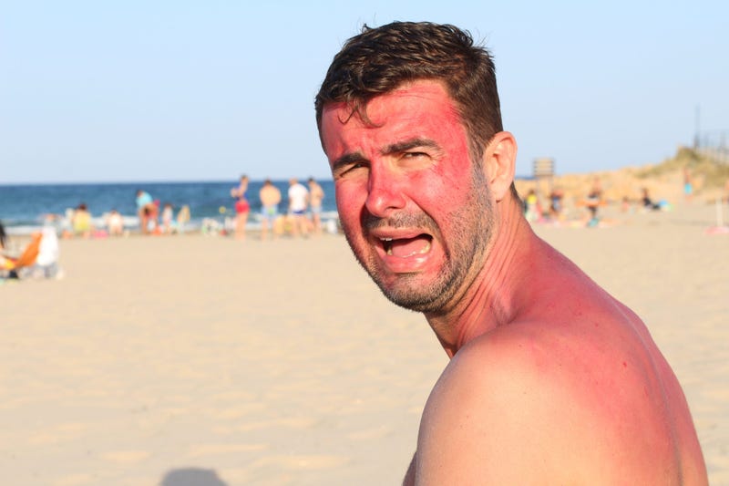 Sunburn Man On Beach